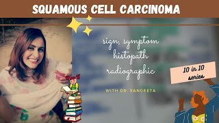 squamous cell carcinoma oral cancer [upl. by Ylra350]