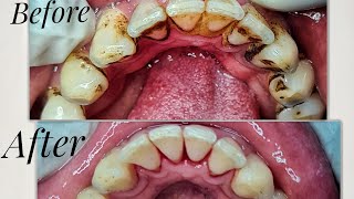 Tartar removal  Dental cleaning using ultrasonic scaler [upl. by Jeffrey]