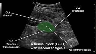 The Anterior Quadratus Lumborum QL Block [upl. by Yks]