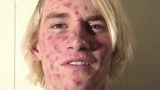 ZIT FACE GUY  PIMPLE ACNE EXPLOSION [upl. by Damien]