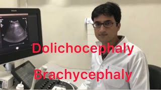 Sonography Dolichocephaly and Brachycephaly [upl. by Madalena]