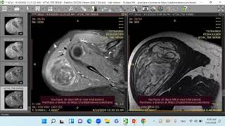 Liposarcoma [upl. by Hillman]