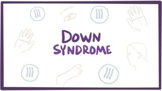 Down syndrome trisomy 21  causes symptoms diagnosis amp pathology [upl. by Philemon]