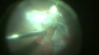 Surgery for Traction Retinal Detachment in Proliferative Diabetic Retinopathy [upl. by Anera]