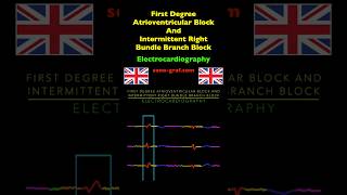 Electrocardiography  First Degree Atrioventricular Block And Intermittent Right Bundle Branch Block [upl. by Laekim466]