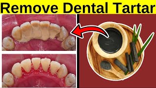 Remove Dental Tartar At Home NATURALLY [upl. by Ayekal466]