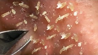 Best Satisfying Nose Plucking Blackheads Whiteheads Removal  Acne Treatment 22 [upl. by Sunny396]