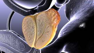 Prostate Cancer Animation [upl. by Wiskind]