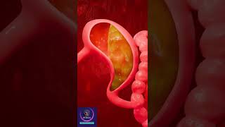 Gastroesophageal reflux disease  GERD Short Explanation [upl. by Hulda]