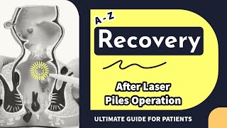 START TO END recovery POINTS after Laser Piles Operation  Laser Haemorrhoidoplasty [upl. by Kirenoj]