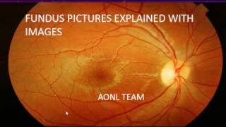 Fundus images explained by an ophthalmologist [upl. by Friedrick]