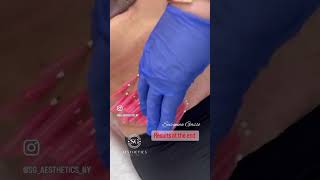 PDO Threads belly skin tightening Watch before and after [upl. by Annoit]