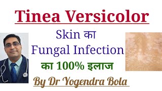 Tinea Versicolor Skin Infection ka 100 Treatment [upl. by Arod]