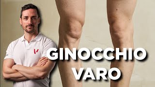 Ginocchio varo esercizi correttivi [upl. by Marlyn]