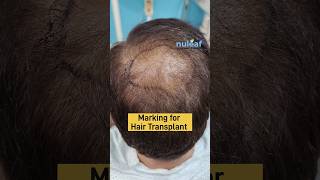 Crown Area Hair Transplant in Pune 1500 Grafts FUE Non trimming using Implanter Pen Fast Recovery [upl. by Suirad663]