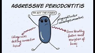 Aggressive Periodontitis Part 1  Etiology and Pathogenesis [upl. by Carline796]