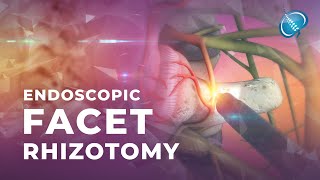 What is Endoscopic Facet Rhizotomy [upl. by Annoeik267]