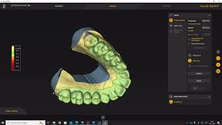 Splint design in de inlab 22 software [upl. by Modesty731]