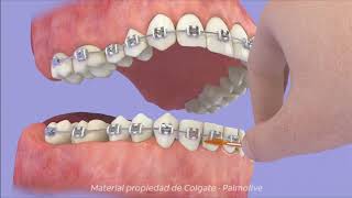 ¿Cómo mantener tu higiene bucal con brackets [upl. by Walther151]