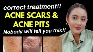 ACNE SCARS amp ACNE PITS  How to treat how to prevent amp what products to use ACNE SCARS TREATMENT [upl. by Nelie338]