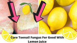 Can Lemons Cure Toenail Fungus [upl. by Mert]