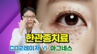 한관종 물사마귀 CO2레이저 치료 VS 아그네스 고주파 치료 한관종아그네스물사마귀 [upl. by Florentia]