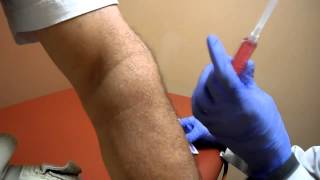 Patient Case Review 52 yoa male Lateral Epicondylitis Tennis Elbow Testimonial Prolotherapy [upl. by Davide146]