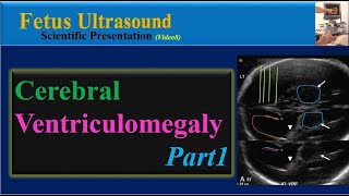 Fetus Ultrasound Cerebral Ventriculomegaly Part1 [upl. by Egiarc]