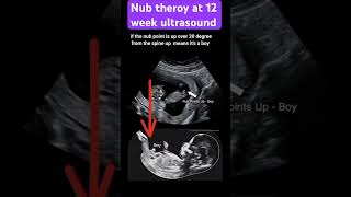 Guess the gender with Nub theory Baby boy or girl pregnancy ultrasound pregnancycare [upl. by Cyprio]