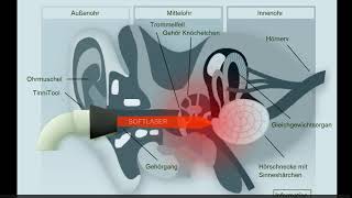 Tinnitool EarLaser Anwendung [upl. by Enialb229]