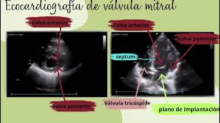 Ecocardiografía de insuficiencia Mitral [upl. by Cross395]