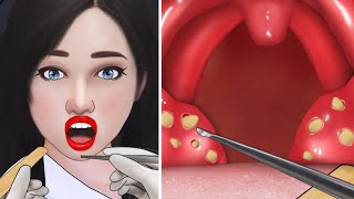 ASMR Cause of bad breath Extreme tonsil stone removal animation [upl. by Ahsitniuq602]