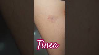 Tinea Infection imwell tinea [upl. by Dlawso]