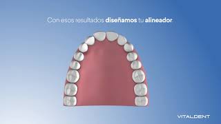 Ortodoncia  ALINEADORES TRANSPARENTES  Vitaldent [upl. by Sidoma]