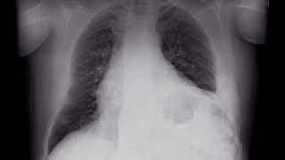 CARDIOMEGALIA EDEMA AGUDO PULMONAR INSUFICIENCIA CARDIACA EN MASCULINO DE 63 AÑOS [upl. by Capello]