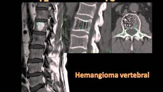 Hemangioma vertebral [upl. by Wylen436]