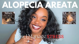 My Journey with Alopecia Areata aka “STRESS SPOT”  Alopecia Areata Treatment [upl. by Alahcim]