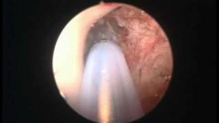 Colloid cyst endoscopy [upl. by Lavella621]