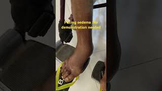 Pitting Edema in Action A Clear SelfDemo [upl. by Odlanyar]