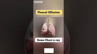 Pleural Effusion amp Chest Xrays [upl. by Akinar]