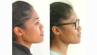 How Orthodontic Extractions can change Facial Profiles [upl. by Areem538]