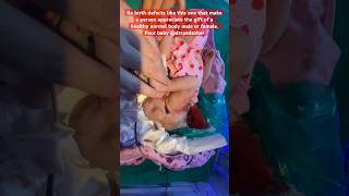 A fatal case of teratoma sad sick gratitude poor blessed Teratoma birthdefects reels cute [upl. by Lisabet]