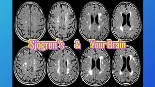 Autoimmune Brain Leisions My Sjogrens Symptoms Part 5 [upl. by Simonne]