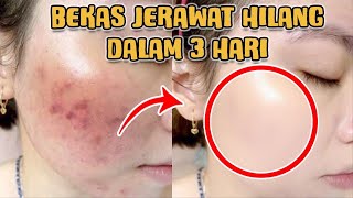 4 TIPS MENGHILANGKAN BEKAS JERAWAT PALING MUDAH DENGAN BAHAN ALAMI [upl. by Elik531]