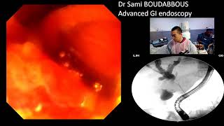 ERCP for Hiliary neoplasic stricture [upl. by Arukas500]