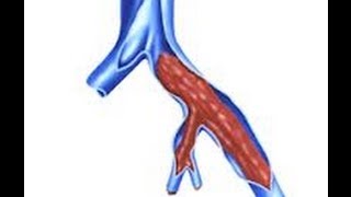 Exame Ultrassonográfico  Trombose Venosa Profunda [upl. by Medora239]