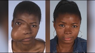 Maxillofacial Surgery Changing Faces Changing Lives  Kadiatus Story [upl. by Bowie]