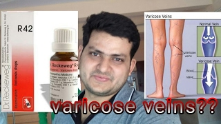 Homeopathic medicine for varicose veins explain [upl. by Bertram]