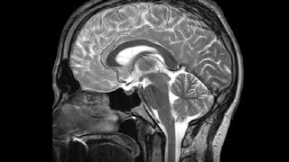 The Ventricles Neuroanatomy Video Lab  Brain Dissections [upl. by Hett]