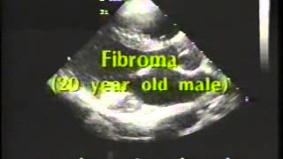 Myxoma Fibroma [upl. by Eocsor]